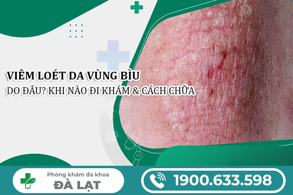 Hình ảnh minh họa